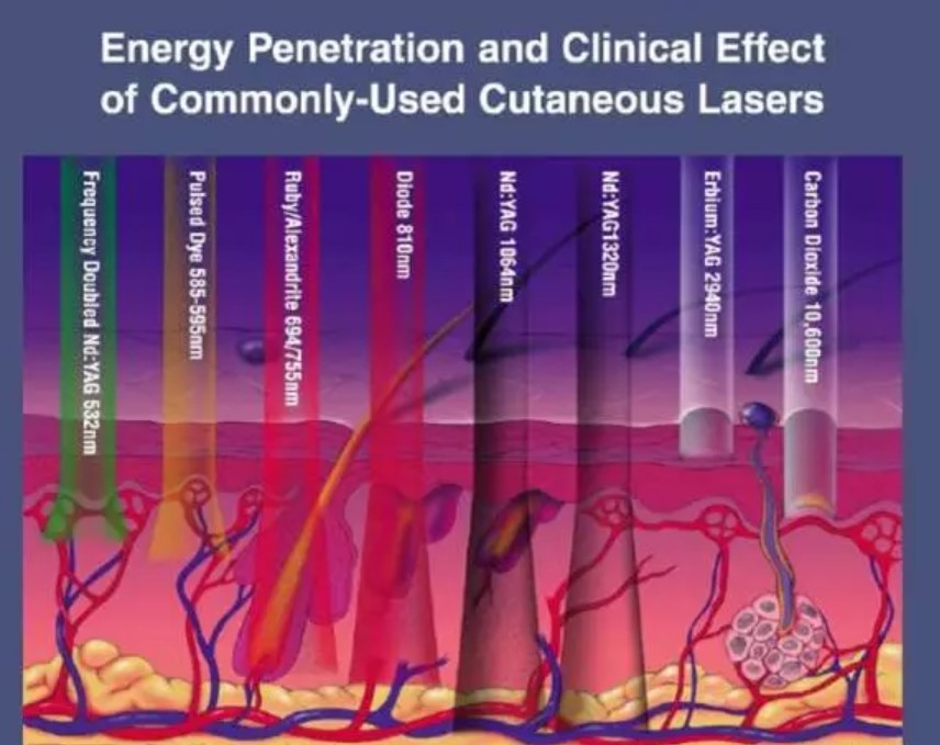 瑞波光电推出美容祛斑用755nm激光芯片